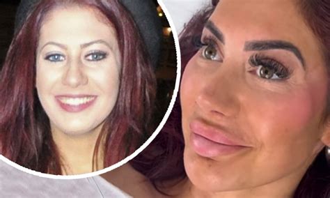 chloe ferry lip filler